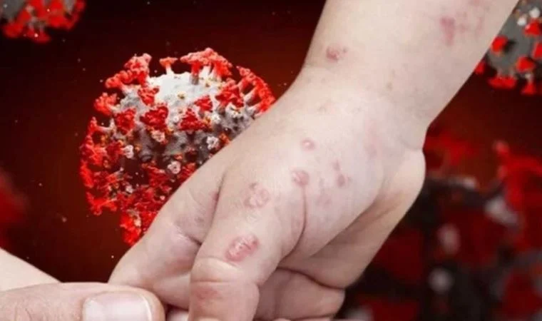 Maymun Çiçeği Virüsü (Monkeypox) ve Hastalığı
